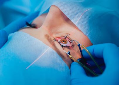 Refractive Surgery
